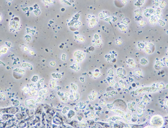 GSK and Oxford researchers to create cancer vaccine to stop disease developing Image